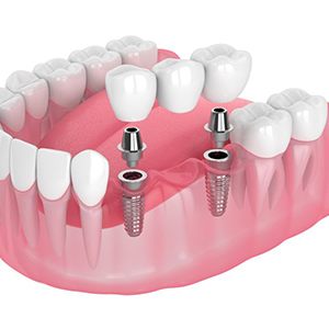Illustration of three-unit dental implant bridge