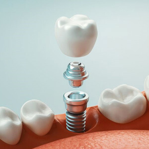 dental implant, abutment and crown between natural teeth