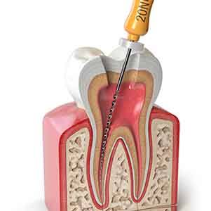 Illustration of root canal therapy being performed