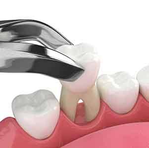 Illustration of tooth extraction being performed