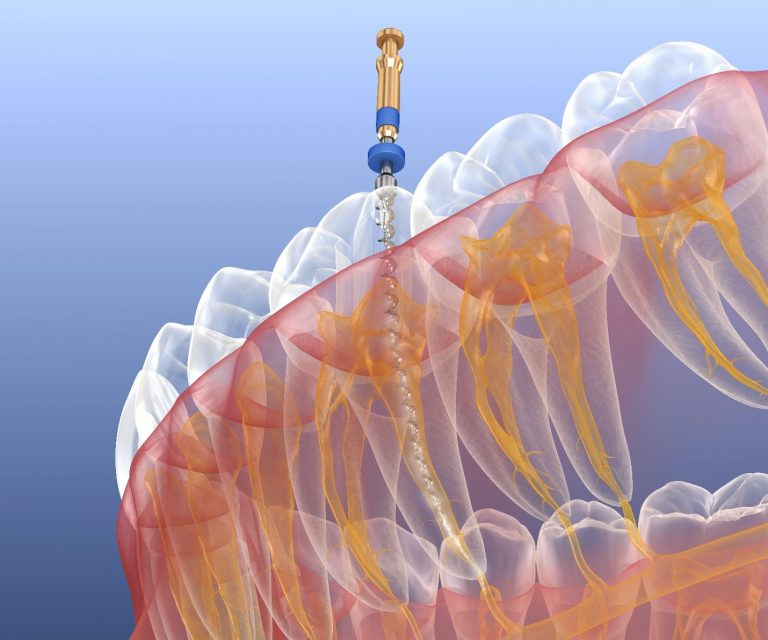 why-might-a-root-canal-have-to-be-redone